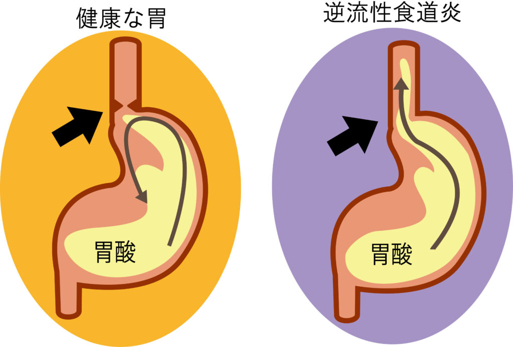 逆流性食道炎とは？