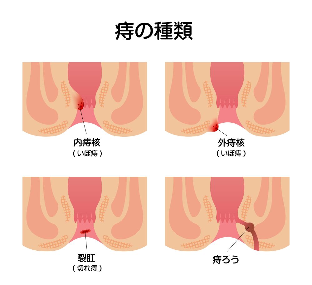痔の種類